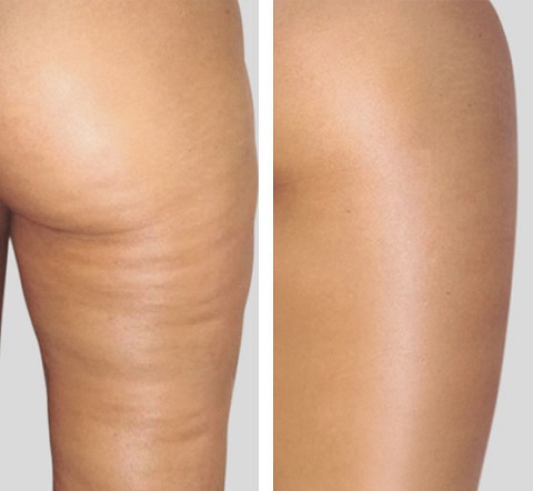 endosphères yhérapy, redustion cellulite, minceur