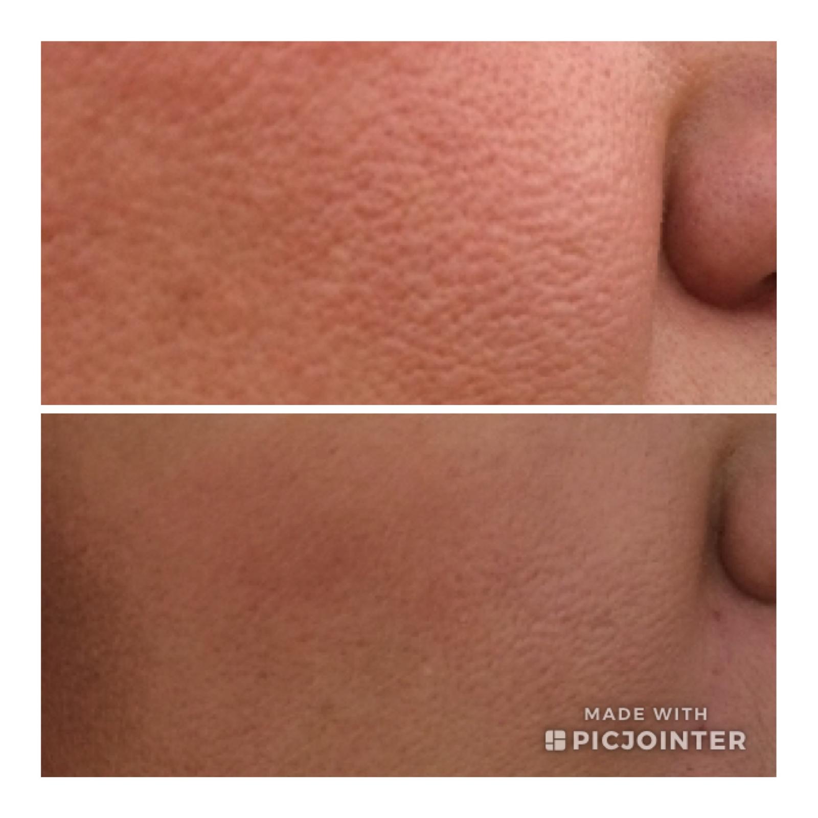 microneedling yvelines